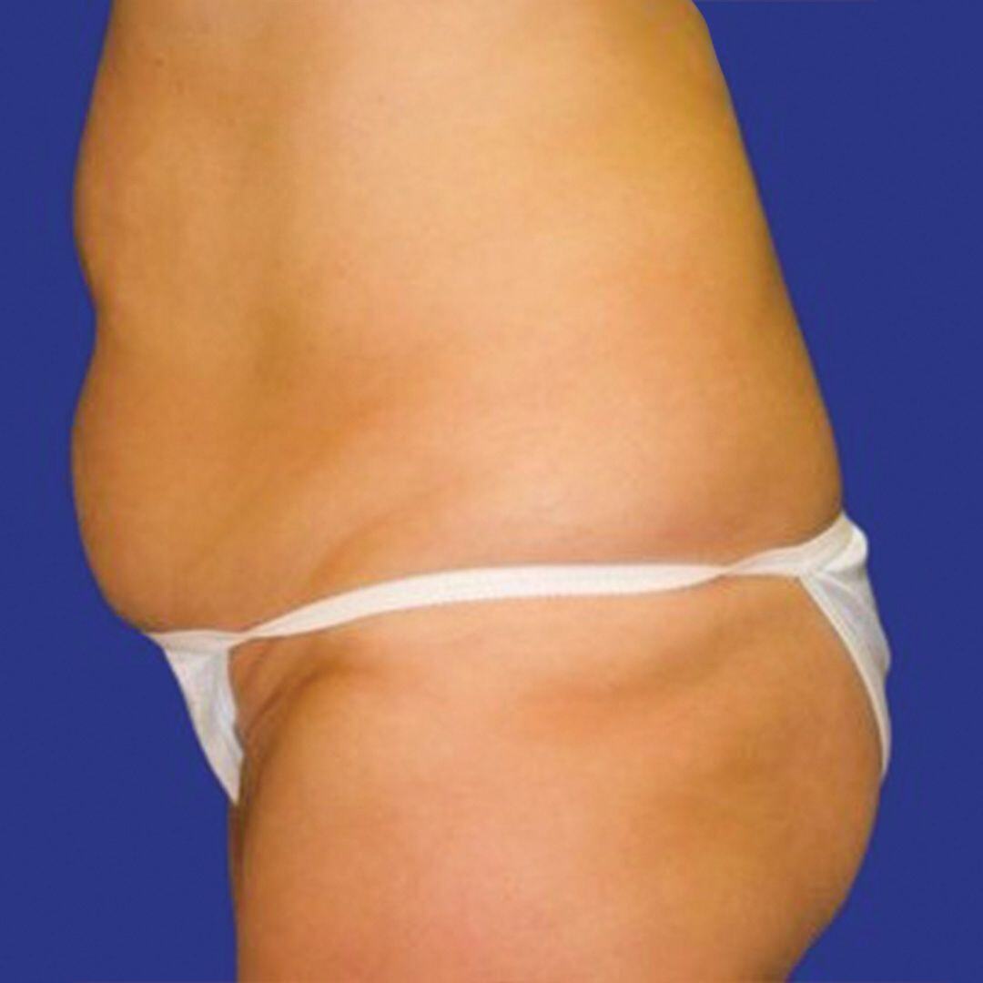 Tummy Tuck 1 Side Before-1