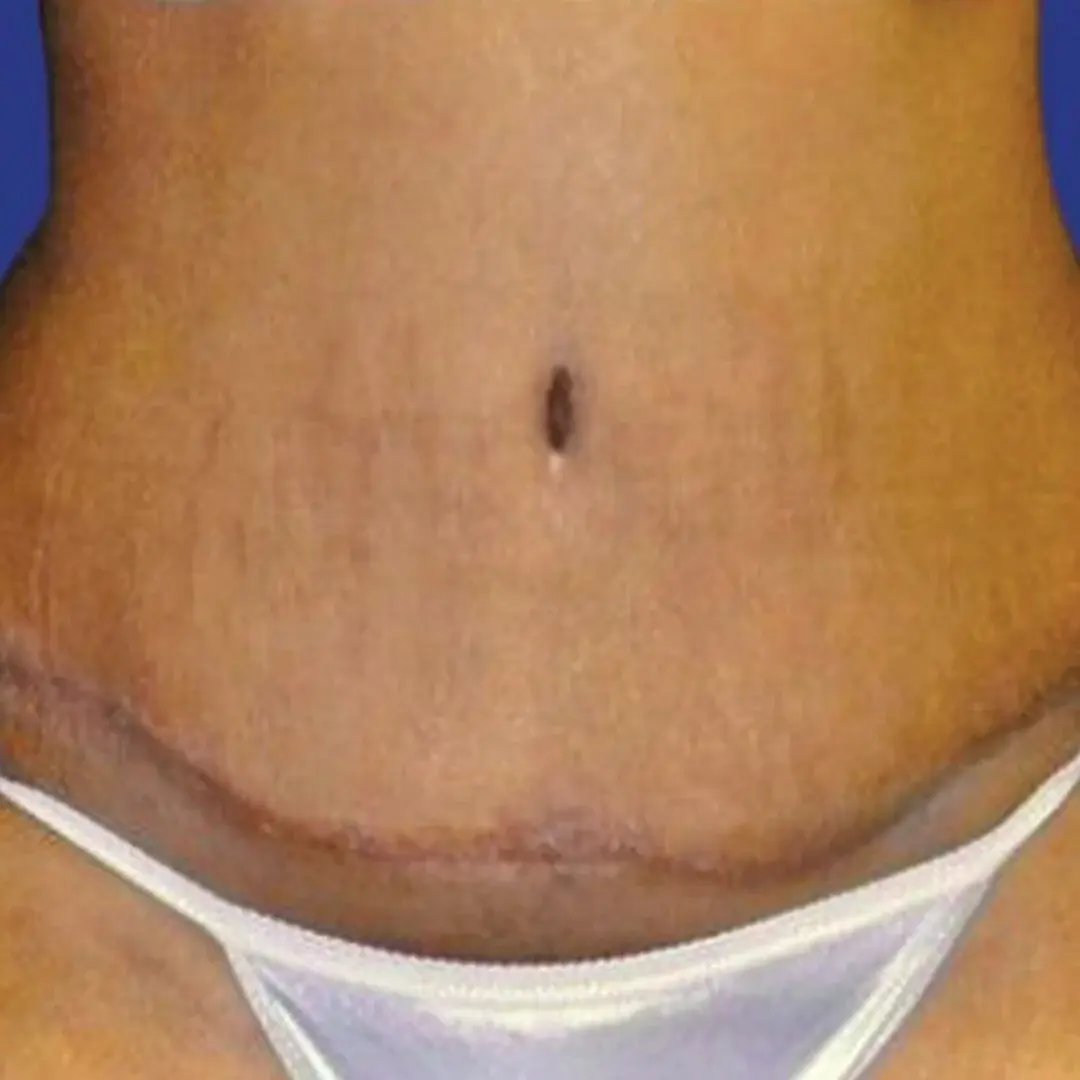 Tummy Tuck 4 Front After