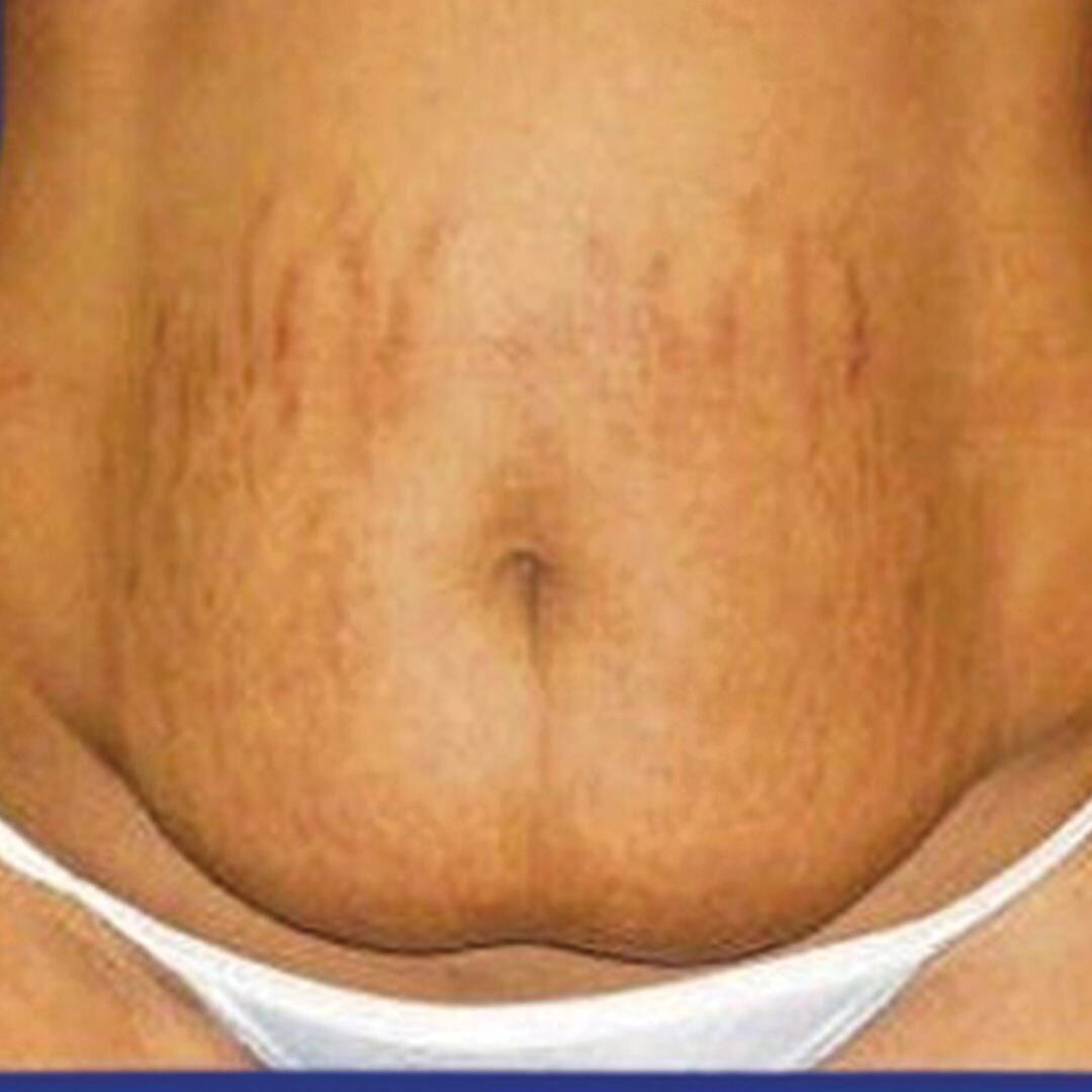 Tummy Tuck 4 Front Before-1