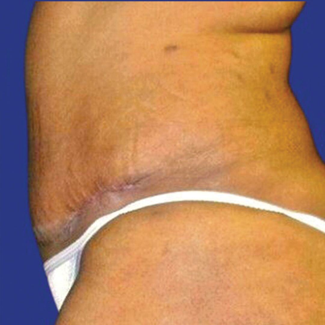 Tummy Tuck 4 Side After-1