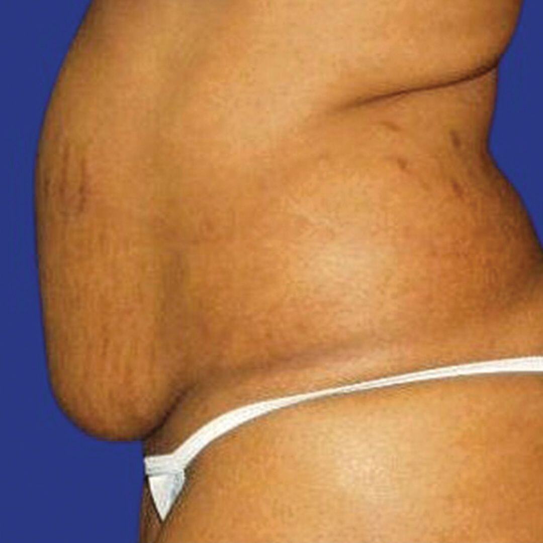 Tummy Tuck 4 Side Before-1