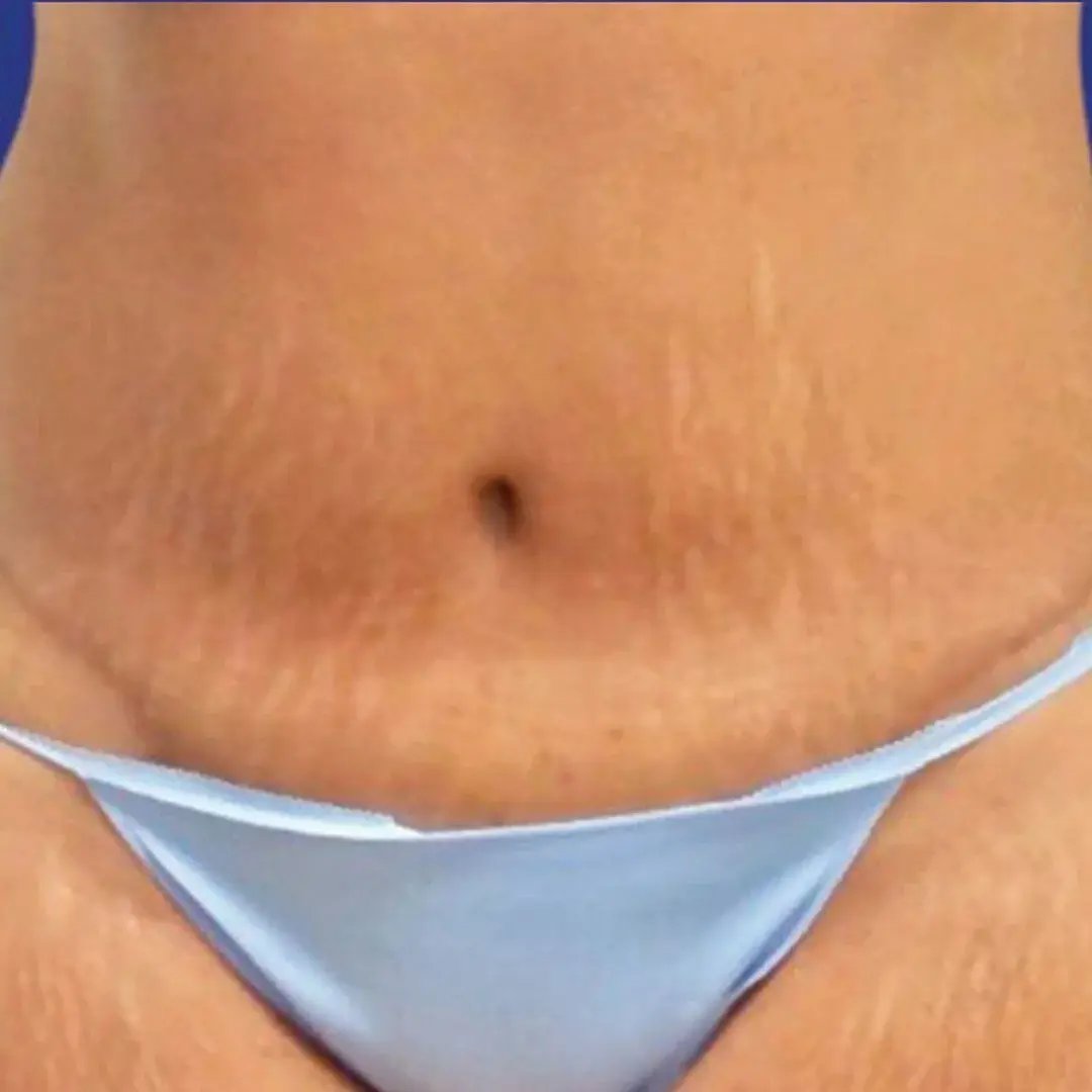 Tummy Tuck 6 Front After