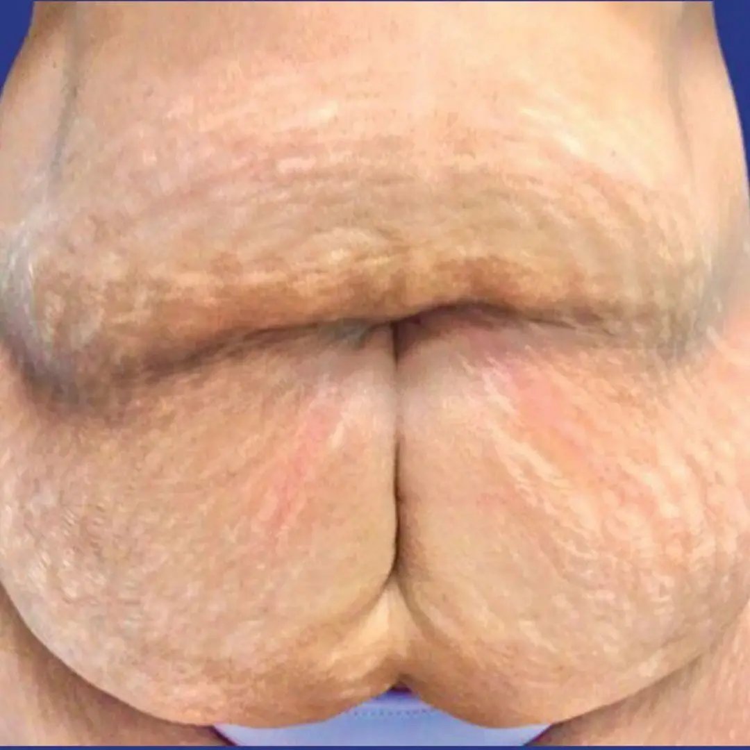 Tummy Tuck 6 Front Before
