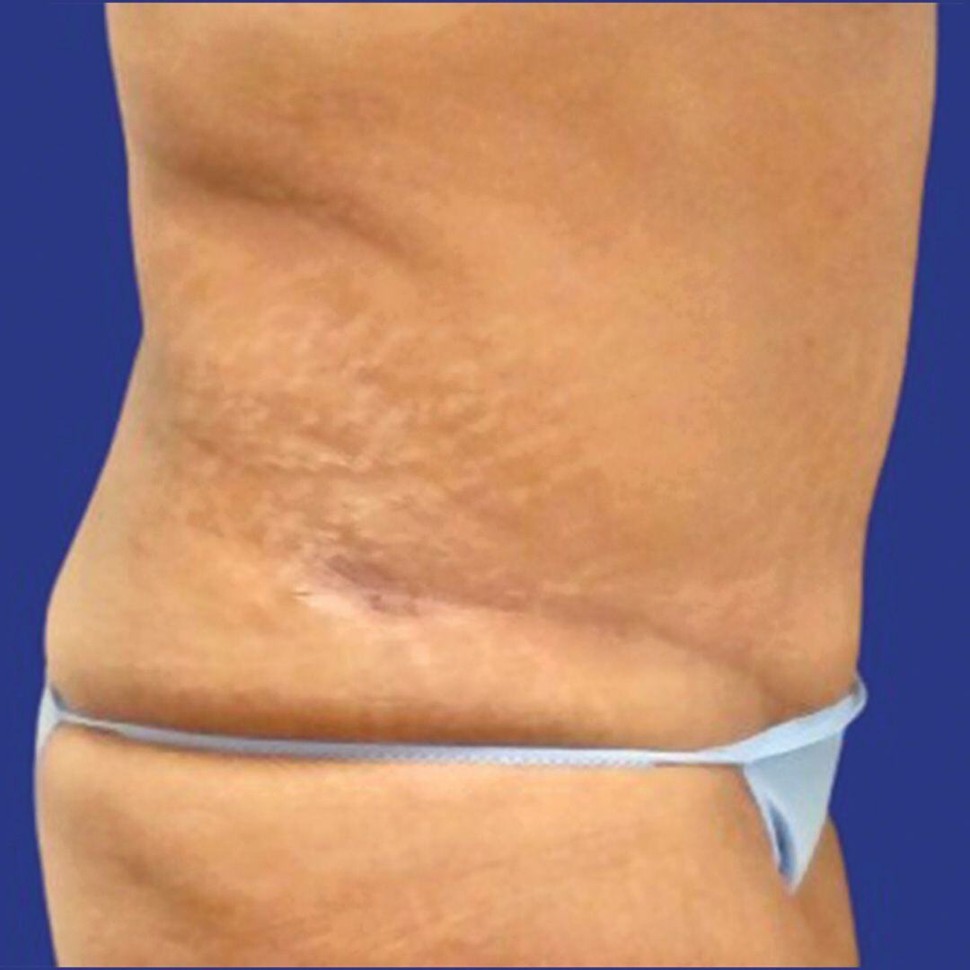 Tummy Tuck 6 Side After-1