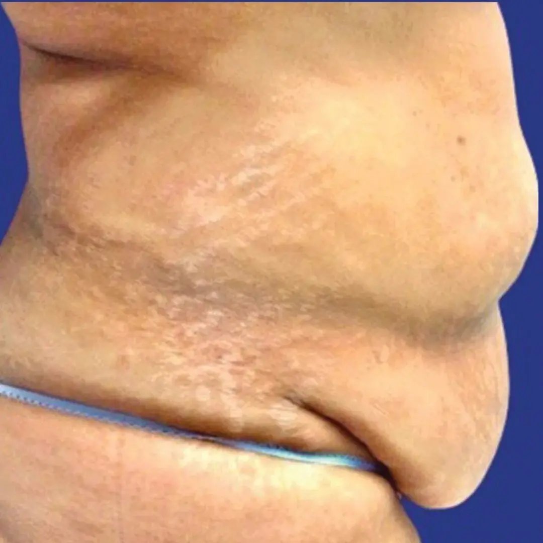 Tummy Tuck 6 Side Before