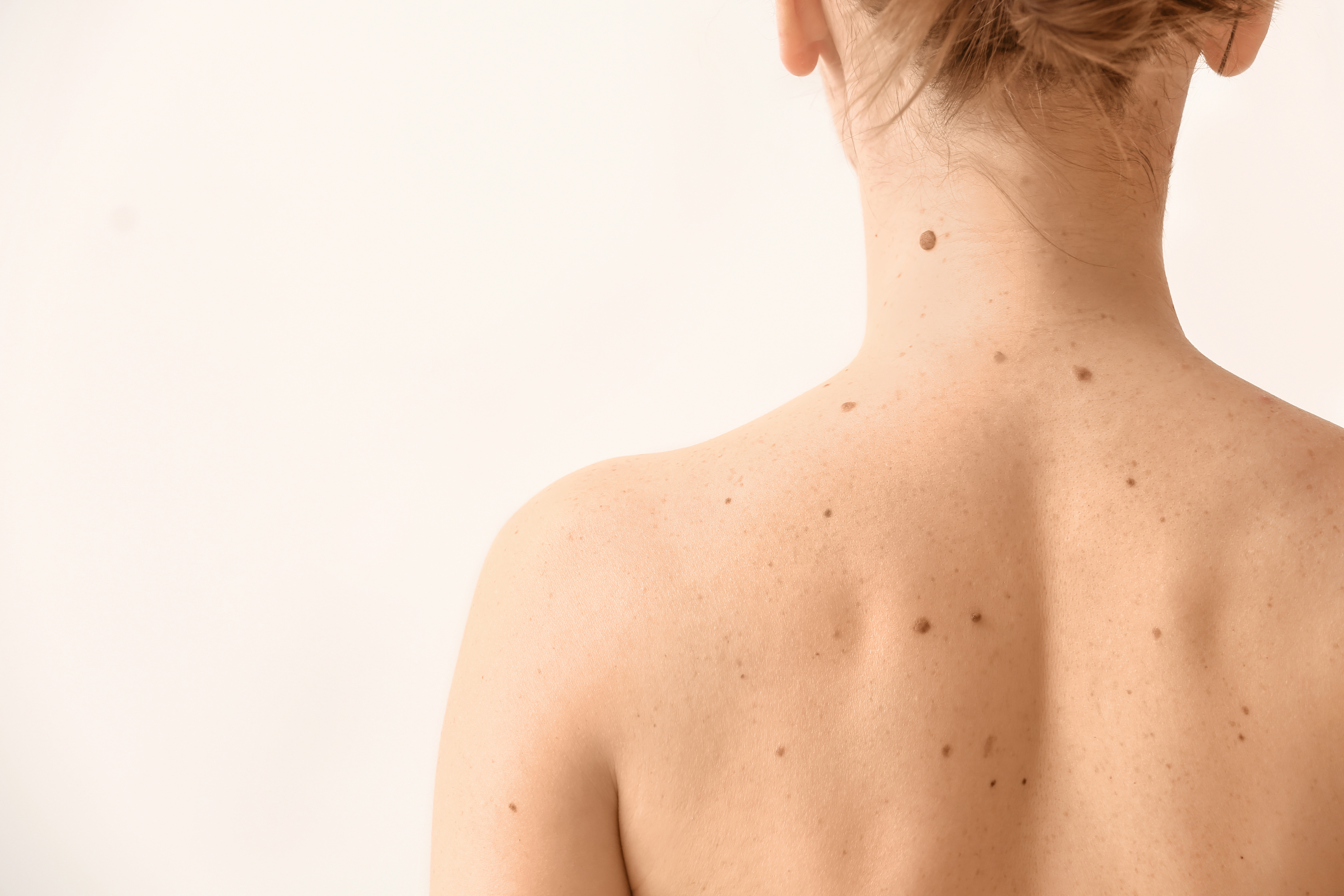 moles-on-back2
