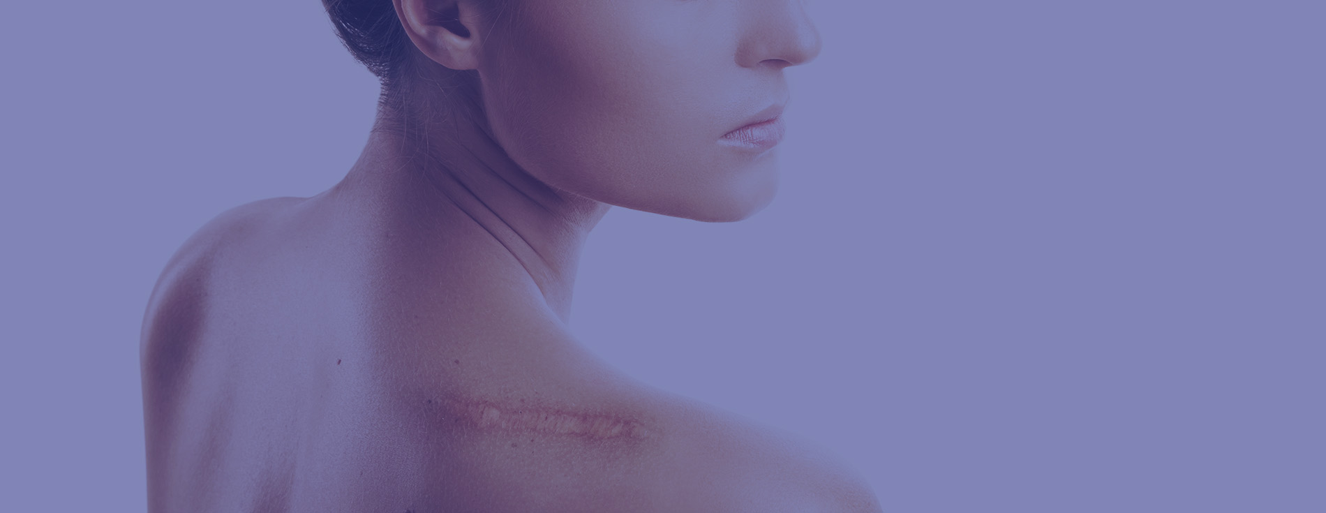 shoulder scar3